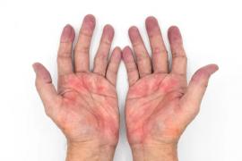 Thấy 3 dấu hiệu này ở bàn tay, có thể bạn đang mắc gan nhiễm mỡ nặng